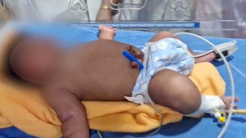 భద్రాచలంలో అద్భుతం.. బాల ‘హనుమంతుడు’ పుట్టాడు..! | భద్రాచలం ఏరియా ఆసుపత్రి పెద్ద దీవెన: 5.2 కేజీల జెయింట్ బేబీ సురక్షితంగా చేరుకోవడం నిజమైన వైద్య అద్భుతం!